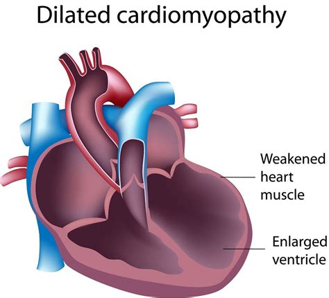 dilated cardiomyopathy life expectancy.